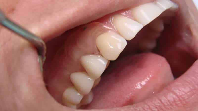 Преимущества зубных силиконовых протезов