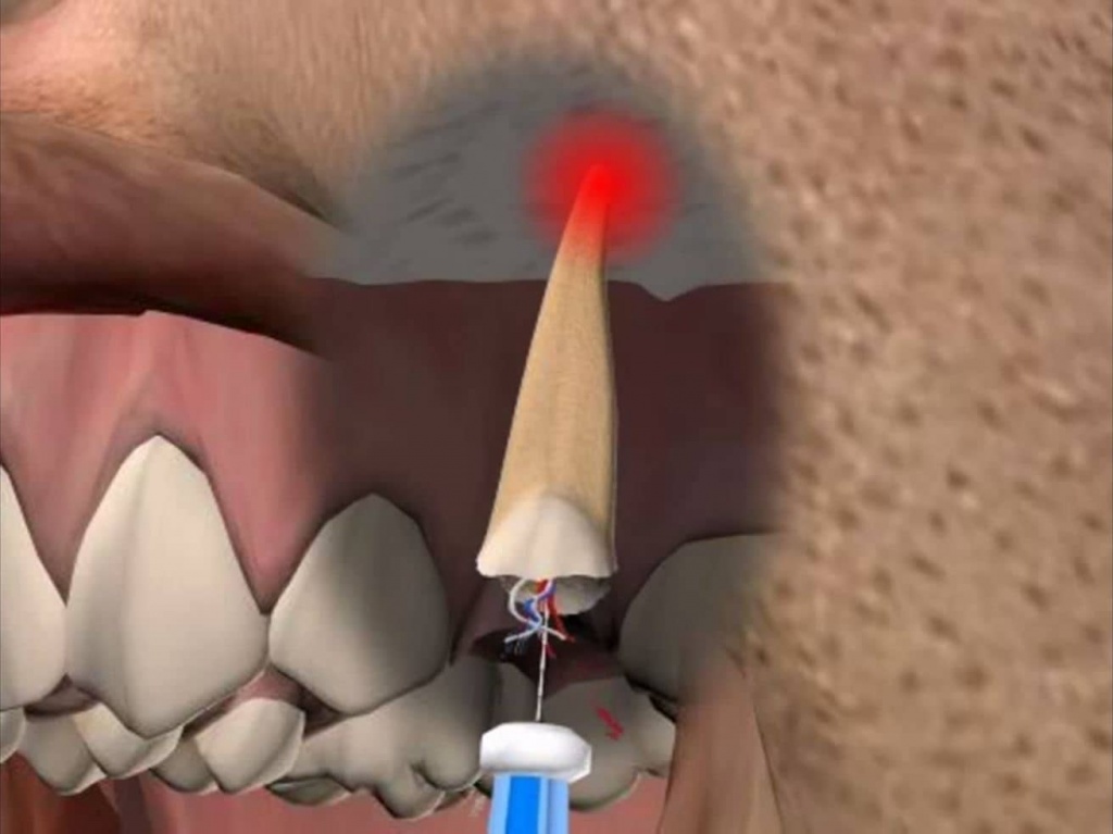 как происходит удаление кисты зуба