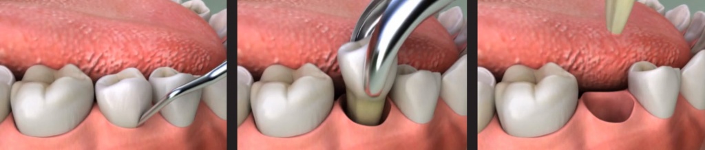 Хирургическое удаление зубов