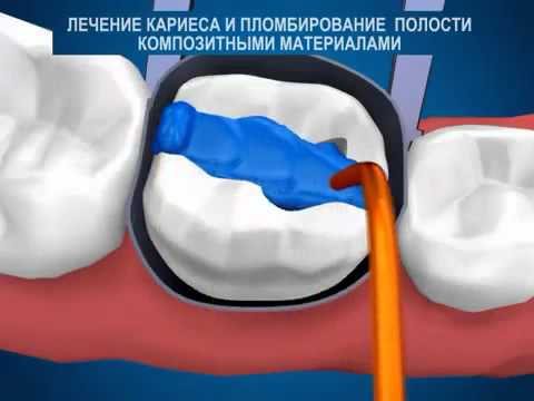 пломбировка каналов зубов