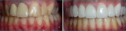Коронки на зубы до и после