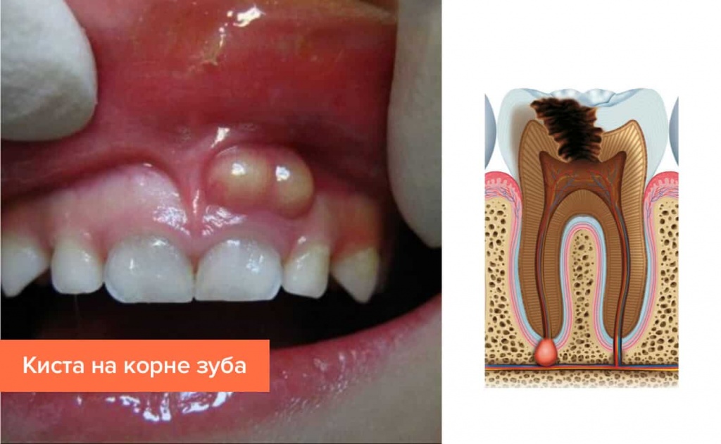 этапы удаления кисты зуба