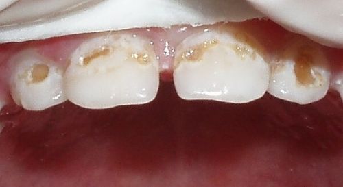 Средний кариес зубов лечение